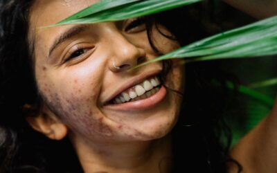 Skin Care Tips for Acne When Traveling